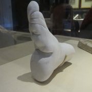 Plâtre montrant la déformation d'un pied après bandage et cassure
